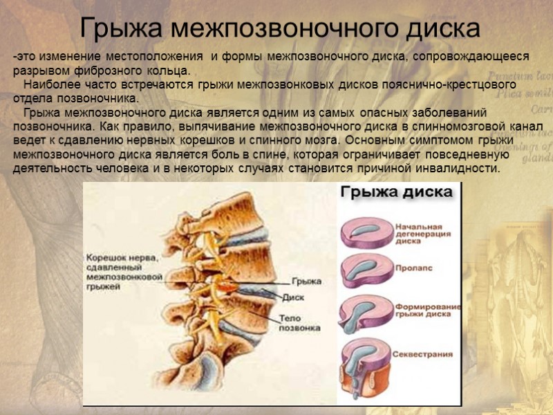 Грыжа межпозвоночного диска -это изменение местоположения  и формы межпозвоночного диска, сопровождающееся  разрывом